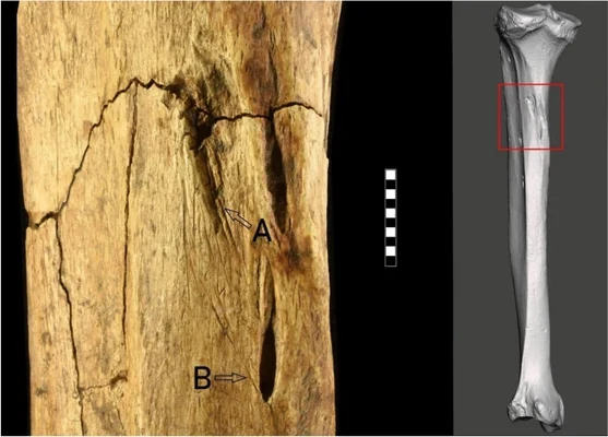 lesione da arma riparo tagliente