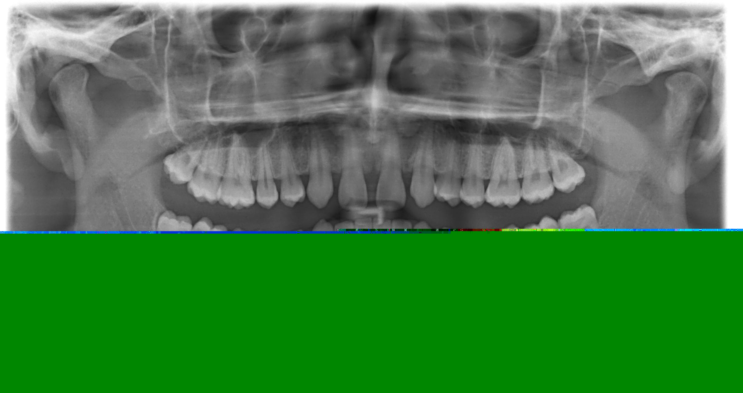 agenesie-dentarie 2.jpg
